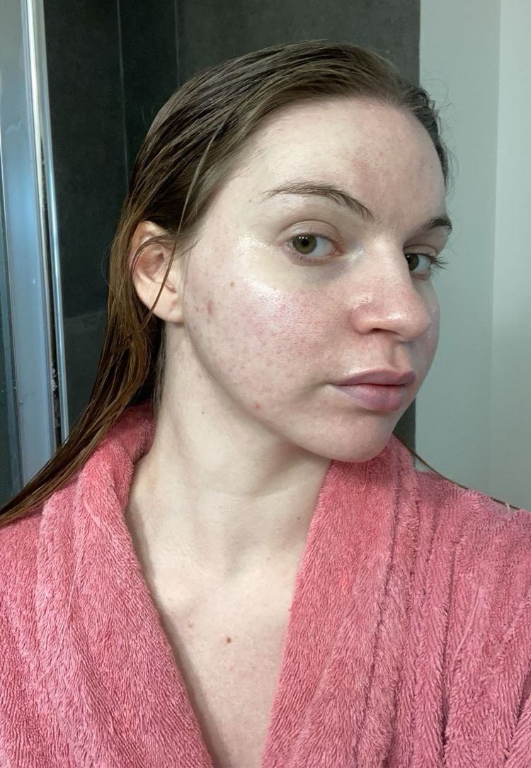 Morgane, la peau marquée par l'acné hormonale